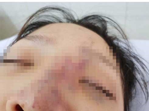 Một nữ sinh có nguy cơ mù mắt vì tiêm filler