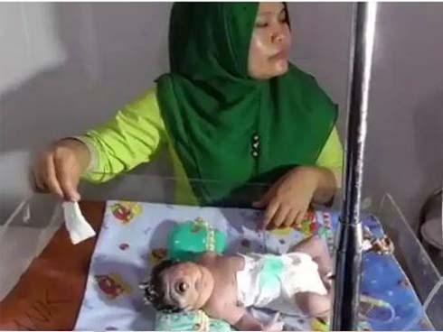 Em bé sinh ra có 1 mắt, chỉ sống được 7 giờ, nghe bác sĩ giải thích nguyên nhân mẹ mới giật mình
