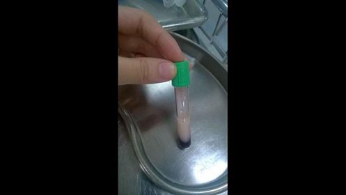 Mỗi ngày 1 bao thuốc và nửa lít rượu, mới 25 tuổi BS đã bó tay không thể cứu-2