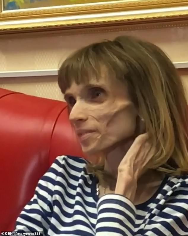 Thực hiện chế độ ăn kiêng nghiêm ngặt trong nhiều năm, cô gái 26 tuổi chỉ nặng vỏn vẹn có 17kg, cơ thể chỉ còn lại da bọc xương-1