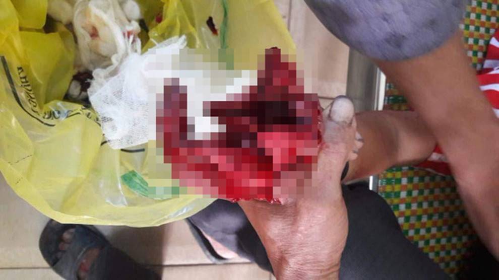 Bé trai 7 tuổi nát 2 bàn tay vì điện thoại phát nổ lúc vừa chơi vừa sạc-1