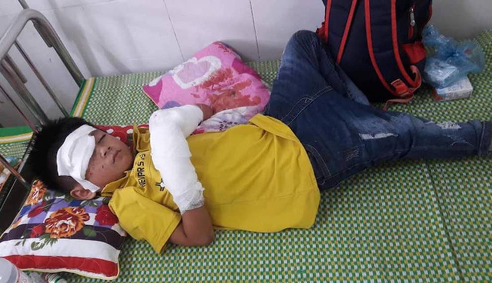 Bé trai 7 tuổi nát 2 bàn tay vì điện thoại phát nổ lúc vừa chơi vừa sạc-2