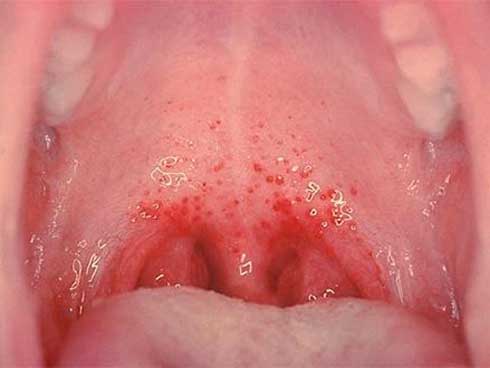 Cậu bé 2 tuổi liên tục chảy nước dãi, cảnh báo bệnh nguy hiểm có thể lây qua nụ hôn”-1