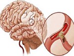 BS cảnh báo: 4 dấu hiệu cho thấy mạch máu đang dần bị tắc, xử lý ngay để tránh nguy hiểm-6