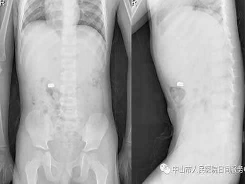 Teo mật bẩm sinh: Căn bệnh khiến bệnh nhân sống trong nỗi ám ảnh chực chờ phải ghép gan-6
