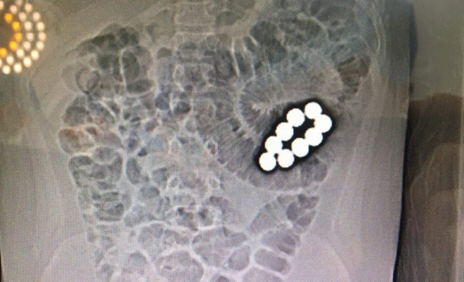 Xôn xao thông tin nam sinh lớp 5 bị hoại tử ruột suýt chết vì bị bạn cùng lớp ép nuốt 9 viên bi sắt-2