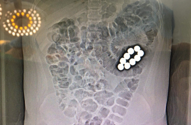 Vụ học sinh lớp 5 nghi bị ép nuốt bi sắt thủng ruột: nhà trường vào cuộc điều tra, học sinh cùng lớp nói gì?-3