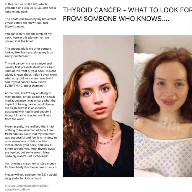 Bức ảnh tiết lộ dấu hiệu ung thư tuyến giáp rất rõ ràng nhưng đáng tiếc là nữ diễn viên trẻ đã không nhận ra-1
