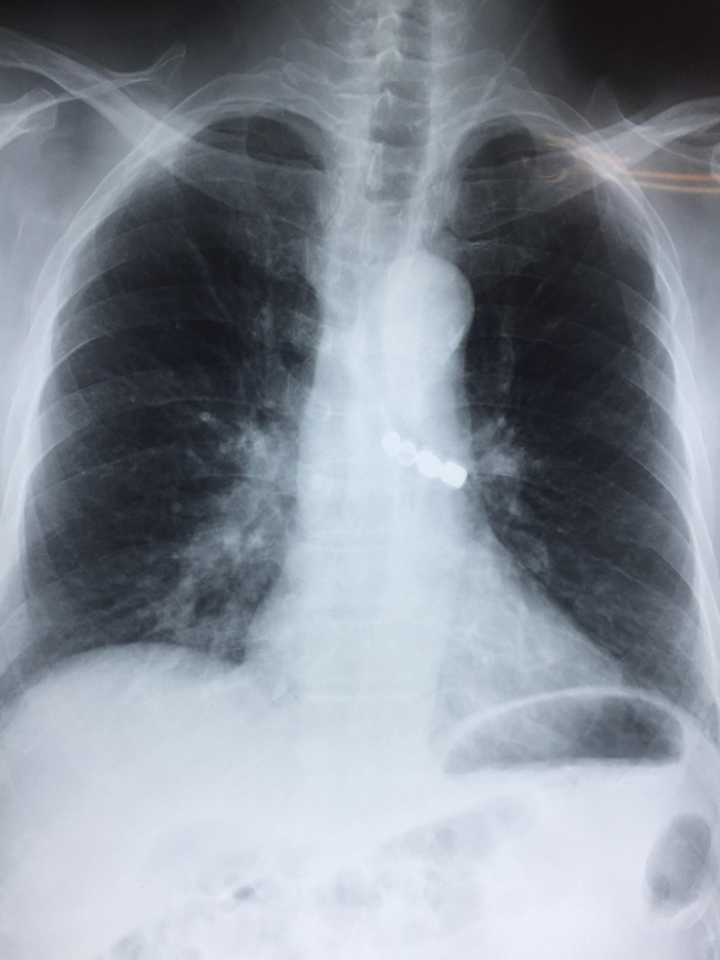 Hy hữu: Cứu sống cụ ông 90 tuổi bị rơi cả hàm răng giả vào phế quản-1