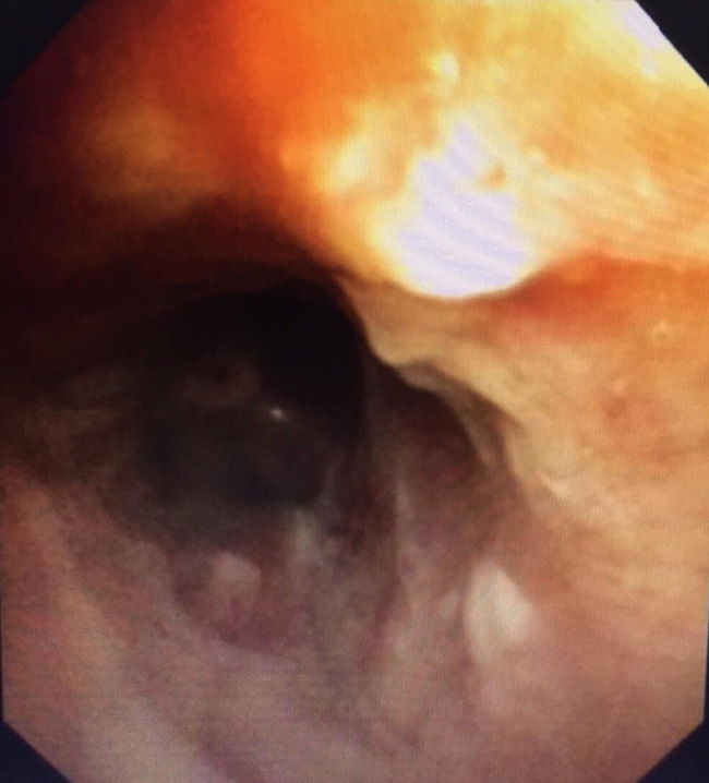 Hy hữu: Cứu sống cụ ông 90 tuổi bị rơi cả hàm răng giả vào phế quản-2