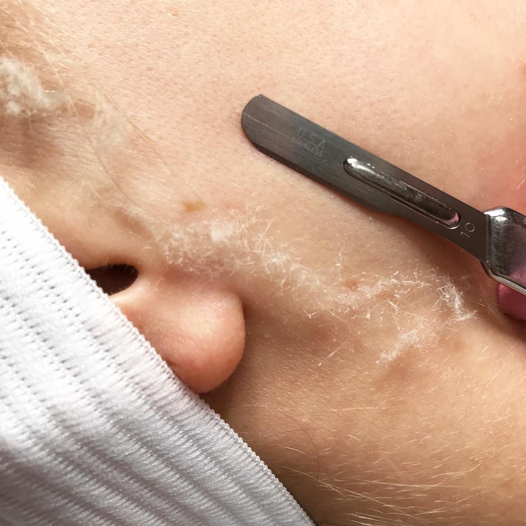 Mục sở thị cạo mặt - phương pháp làm đẹp ghê rợn nhưng sướng mắt, da mịn như da em bé-4