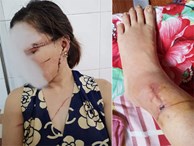 Thông tin mới nhất vụ chồng dùng dao rạch mặt, cắt gân chân 'vợ hờ' ở Bắc Giang