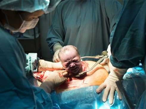 Clip: Chứng kiến quá trình gây tê tủy sống trước khi sinh mổ, chị em bảo nhau: “Thôi cố gắng đẻ thường!”