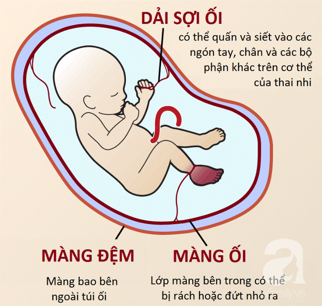 Mẹ lặng người khi sinh con ra không có bàn tay, bác sĩ mổ tìm thấy 1 bàn tay bé xíu còn nằm trong tử cung-4