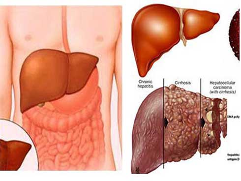 Khi nào người mắc bệnh gan không còn cơ hội cứu chữa?-1