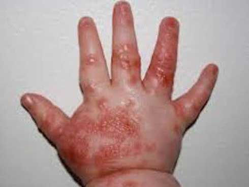 Bé gái 2 tuổi tử vong do bệnh tay chân miệng ở Bến Tre