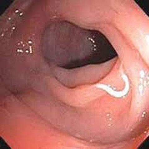 Người phụ nữ nôn ra gần trăm vật lạ hình sợi, nội soi dạ dày bác sĩ mới giật mình-2