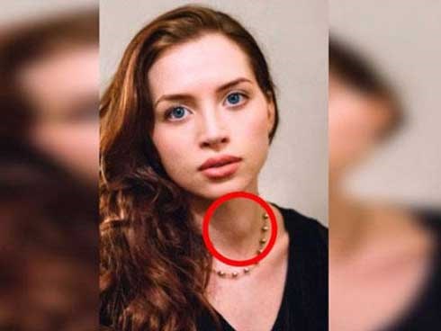 Bức ảnh tố dấu hiệu ung thư tuyến giáp từ 1 năm trước nhưng cô gái không nhận ra