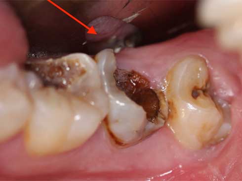 Chuyện gì sẽ xảy ra nếu bạn có một chiếc răng sâu và không chịu chữa trị ngay?-1