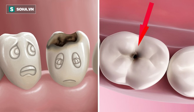 Chuyện gì sẽ xảy ra nếu bạn có một chiếc răng sâu và không chịu chữa trị ngay?-2