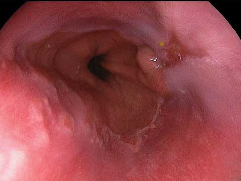 Thức uống này là nguyên nhân khiến người phụ nữ bị tổn thương thực quản, rất nhiều dân văn phòng cũng hay uống-2