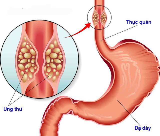 Chỉ cần thấy 1 trong 4 dấu hiệu này lặp lại 2 tuần: Bạn nên đi khám ung thư thực quản gấp-2