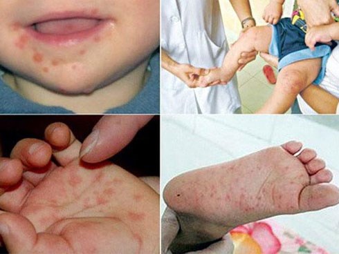 6 sai lầm của cha mẹ khiến trẻ bị tay chân miệng ngày càng nặng hơn