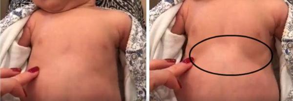 Thấy con thở với dấu hiệu lạ trên ngực, mẹ mau chóng quay lại video giúp cứu sống con-1