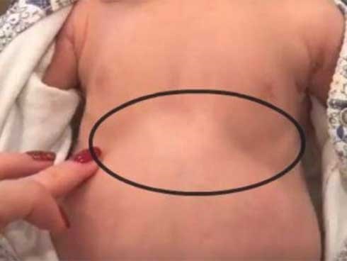Thấy con thở với dấu hiệu lạ trên ngực, mẹ mau chóng quay lại video giúp cứu sống con