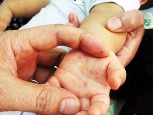 Để không tử vong khi mắc tay chân miệng, Bộ Y tế khuyến cáo 6 điều cần phải làm ngay-1