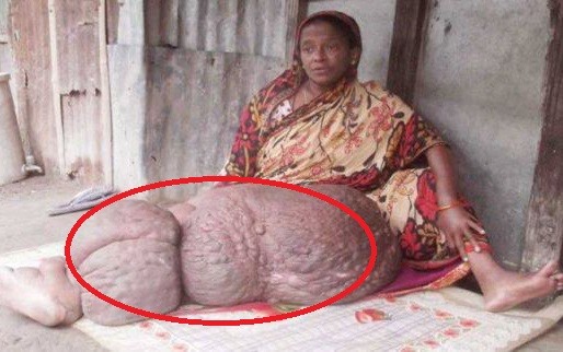 Chân biến dạng nặng gần 60 kg khiến người phụ nữ không thể cử động suốt 18 năm-1