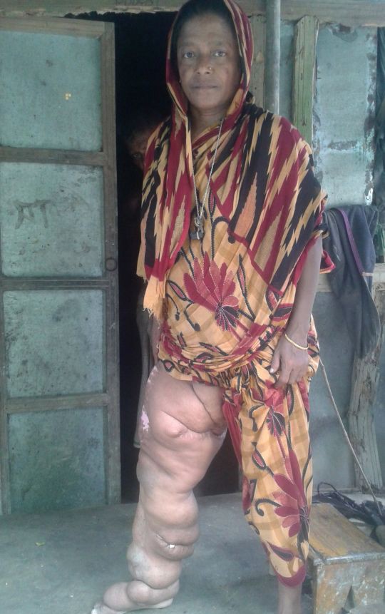 Chân biến dạng nặng gần 60 kg khiến người phụ nữ không thể cử động suốt 18 năm-2