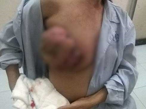 Bác sĩ ‘choáng’, giữa thủ đô bôi nước mắm chữa ung thư