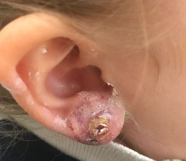 Nguy hiểm từ việc bấm lỗ tai làm đẹp cho bé ít cha mẹ nào nghĩ tới-2