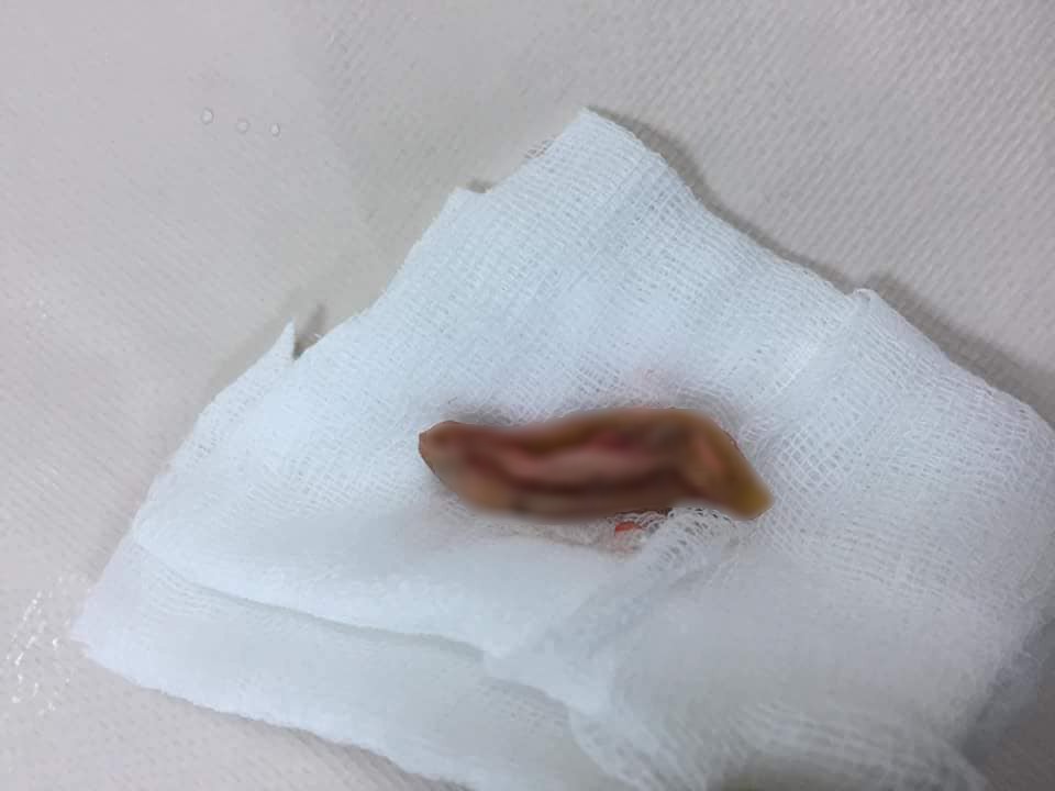 Nam sinh nghi ngáo đá cắn đứt rồi nuốt tai phải của bạn vào bụng-2