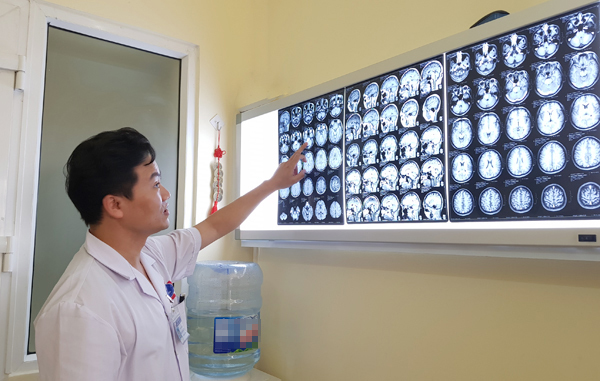 Người đàn ông suýt chết vì đột quỵ, bất ngờ phát hiện mắc u não-1