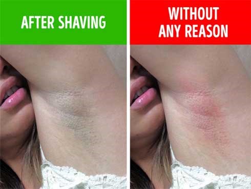 Đừng cố tình bỏ qua 6 biểu hiện ở nách vì nó có thể chỉ ra bệnh tiềm ẩn, không ngoại trừ ung thư