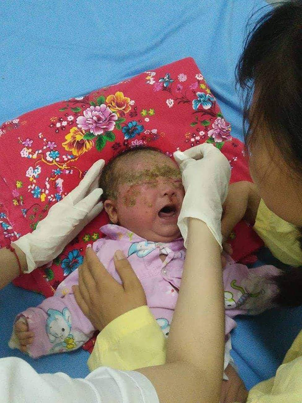 Bé trai 32 ngày tuổi nguy kịch do sai lầm của mẹ dùng nước lá tắm cho con-2