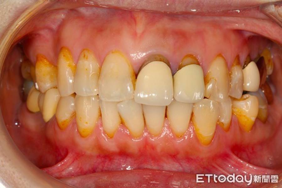 Uống trà sữa trân chân, cô gái bị viêm khớp thái dương hàm: Lời cảnh báo cho những cô gái hay làm việc này khi uống trà sữa-3