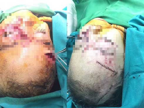 Bé 31 tháng tuổi bị chó nhà cắn nhiều nhát vào mặt, phải nhập viện cấp cứu-1