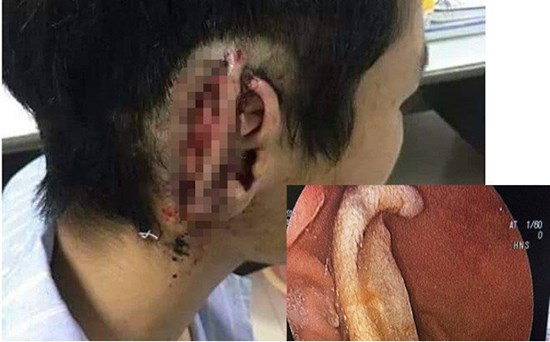 Công an vào cuộc vụ nam sinh cắn đứt tai bạn rồi nuốt luôn vào bụng