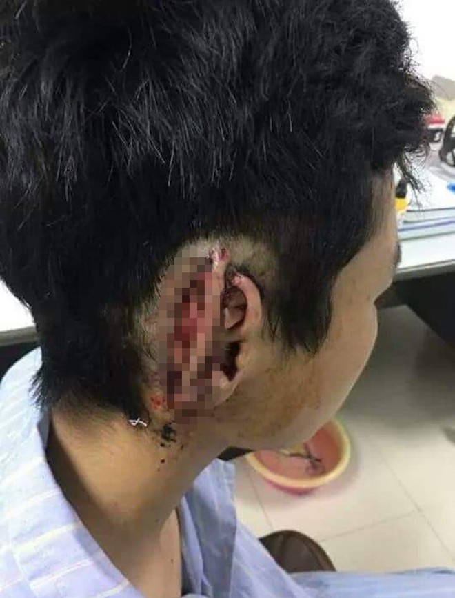 Công an vào cuộc vụ nam sinh cắn đứt tai bạn rồi nuốt luôn vào bụng-1