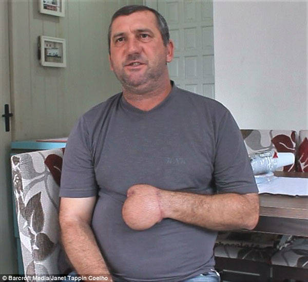 Bác sĩ khâu tay người đàn ông vào dạ dày và cái kết bất ngờ-5