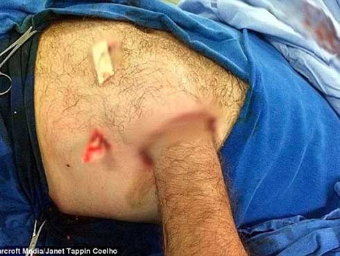 Bác sĩ khâu tay người đàn ông vào dạ dày và cái kết bất ngờ-3