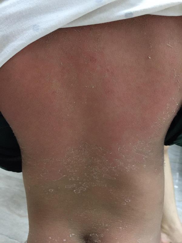 Nghĩ con cảm cúm mẹ tự mua thuốc cho uống, sau 4 ngày bé gái bong tróc da toàn thân-2