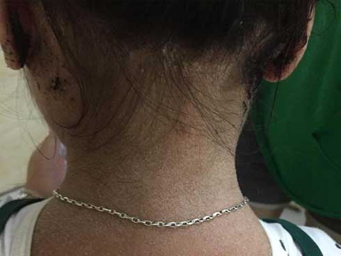 Nghĩ con cảm cúm mẹ tự mua thuốc cho uống, sau 4 ngày bé gái bong tróc da toàn thân-1