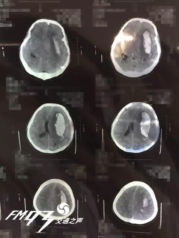 Chàng trai trẻ 29 tuổi bị xuất huyết não, thói quen tai hại của anh nhiều người có-1