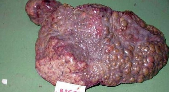 Người Việt có tỷ lệ mắc ung thư gan rất cao: BS bệnh viện K chỉ các nguyên nhân gây bệnh-2