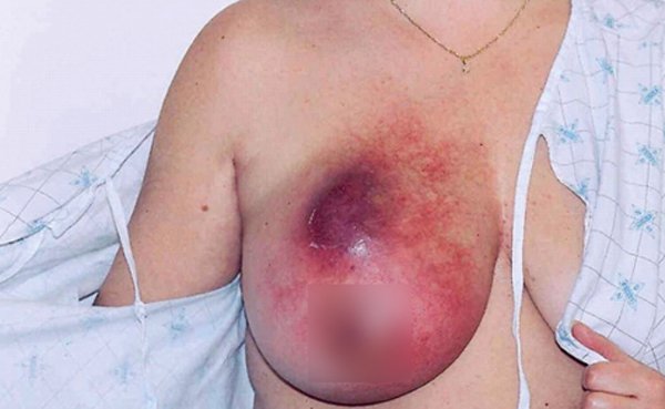 Thiếu nữ Hà Nội 18 tuổi rụng rời phát hiện ung thư vú-2