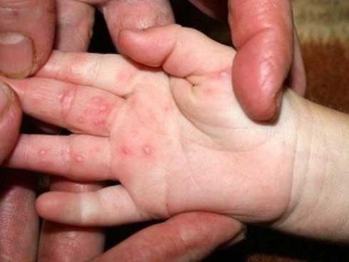 Chi tiết bệnh tay chân miệng qua 10 câu hỏi, trong đó câu thứ 6 các mẹ phải ghi nhớ